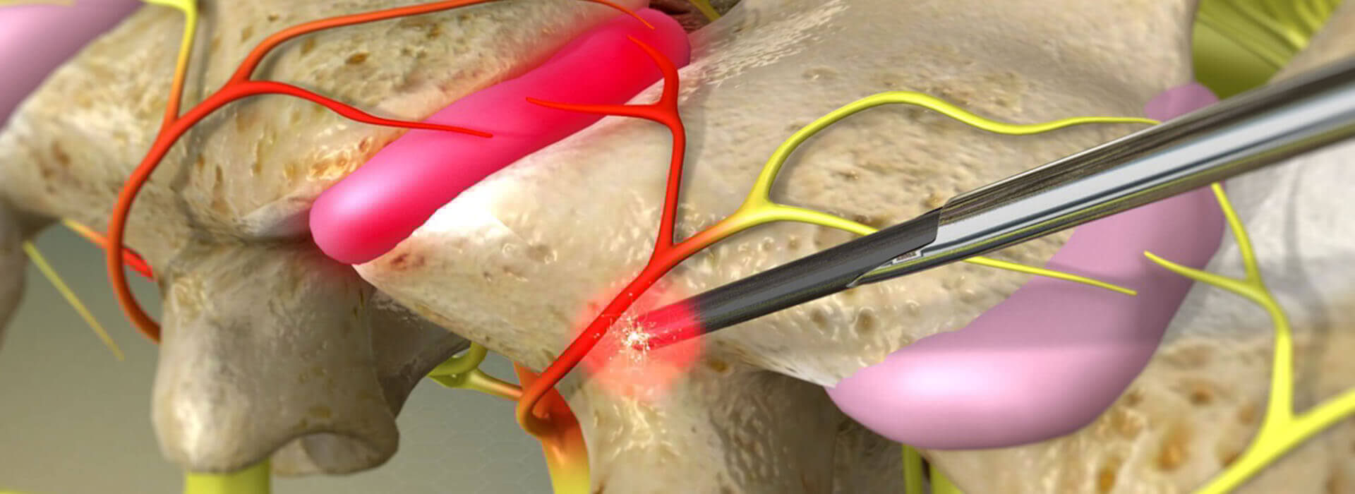 Cure Medkin now perform Rhizotomy surgery! - Cure Day Hospitals
